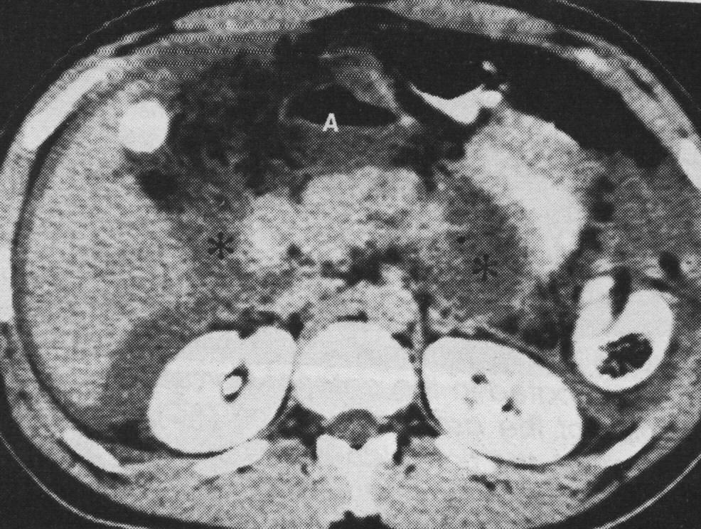 Pancreas sérülések -28-49%-ban máj,