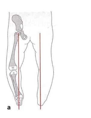 Az alsó végtag konstrukciós tengelye Zilles-Tillmann