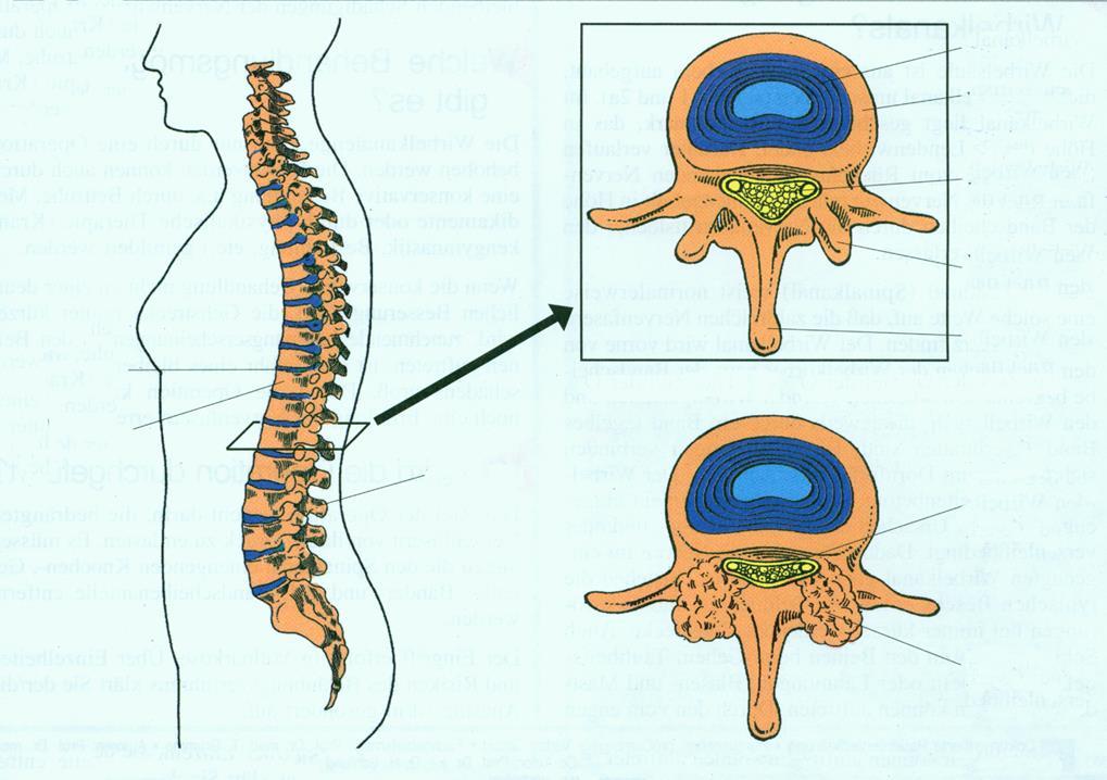Melyek a betegség alapvető tünetei? Fájdalom: - A deréktáji, övszerű és/vagy a tompor, comb és térd irányában a végtag hátsó-külső felszínén futó fájdalom a gerinc tartóelemeiből eredhet.