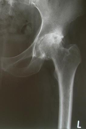 Csípő artroplasztika után. Alsó végtagi nagyízületi endoprotetikai profil | Ortopédiai Klinika