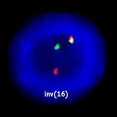 AML1 AML1/ETO RARα PML PML/RARα t(8;21)(q22;q22) (AML1/ETO)