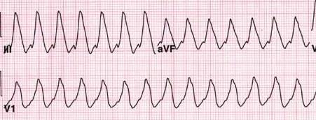A defibrillátor/monitor csatlakoztatása után a legfontosabb eldöntendő kérdés a keringésmegállás hátterében lévő ritmus elemzése,