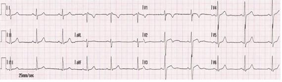 szemben. Sokkolandó ritmus: VF-kamrafibrilláció, pnvt-pulzus nélküli kamrai tachycardia). 1. ábra VF 2.