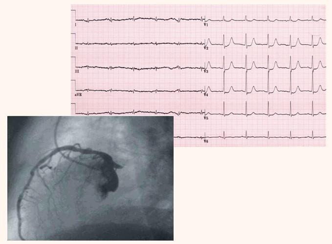 1. ábra Valódi poszterior infarctus EKG képe és a bal koszorúér koronarogramja, mely a körbefutó koszorúér ág proximális okklúzióját igazolja.