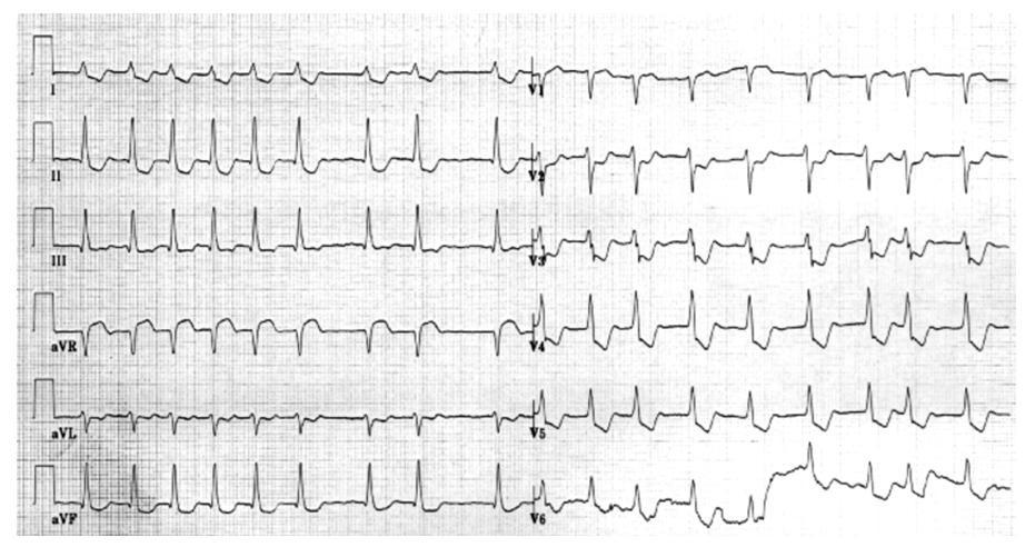 2. ábra Kritikus bal közös törzs szűkületben továbbá súlyos jobb koszorúér betegségben szenvedő beteg EKG felvétele. A felvétel pitvarfibrilláció idején készült.