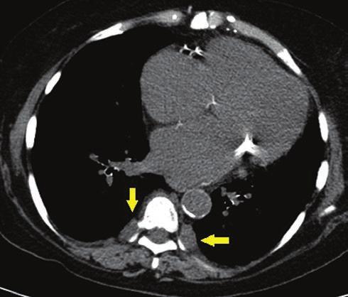 52 KÖRÖSMEZEY ÉS MTSAI traktusban (45). Extramedulláris hematopotézis CT-képe a 2. ábrán látható.