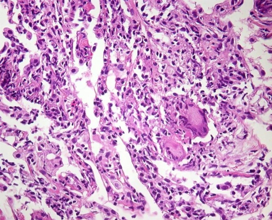 A hiperszenzitív pneumonitis szövettani diagnosztikája Sebészi tüdőbiopszia (többnyire csak differenciáldiagnosztikai célból indikált) A pathológiai eltéréseket az antigén típusa kevéssé