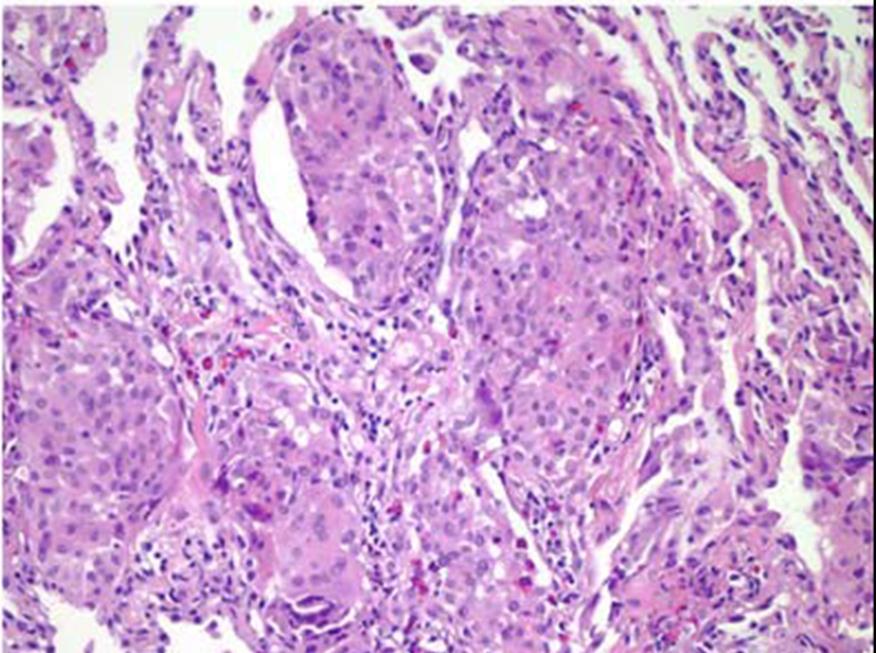 néhány óriássejtet tartalmazó (sarcoid-like) granulomák, proliferatív obliteráló bronchiolitis Chronicus HP: kevéssé különbözik az egyéb előrehaladott fibrózisoktól, a szöveti kép UIP-re, fibrotizáló