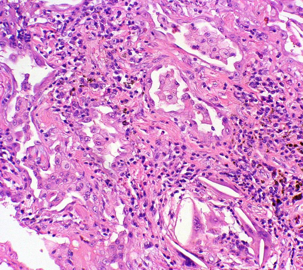 A hiperszenzitív pneumonitis szövettani diagnosztikája Interstitium szaporulat lobosodással és