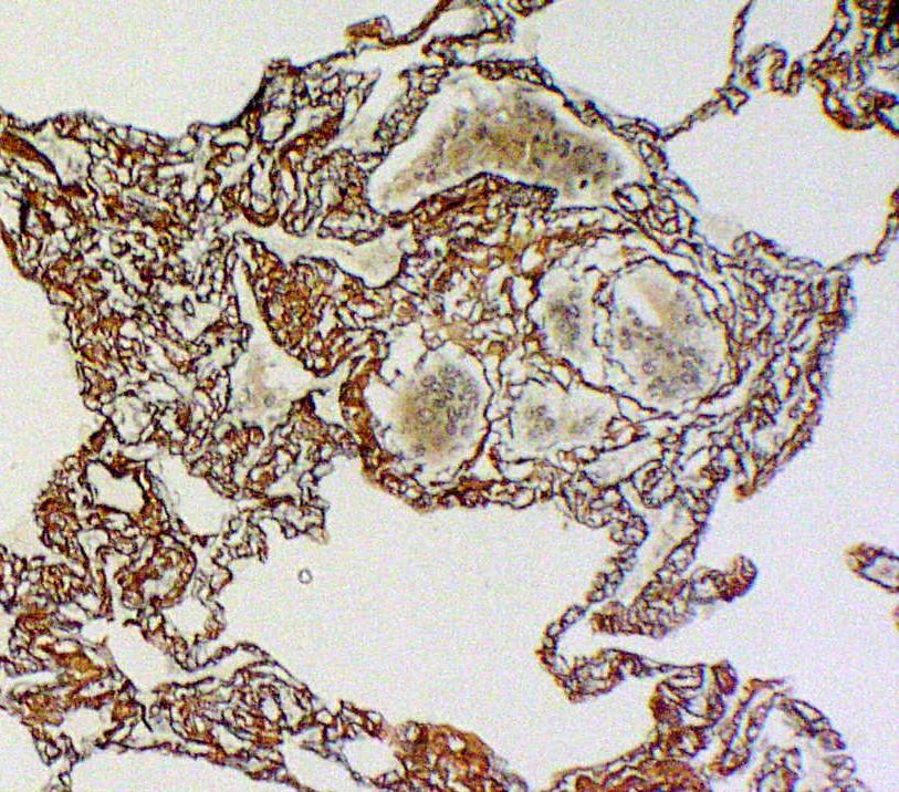 A hiperszenzitív pneumonitis szövettani diagnosztikája A granulációs