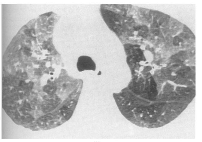 identifying areas of lung that either (a) failed to increase normally in attenuation and/or (b) decrease in