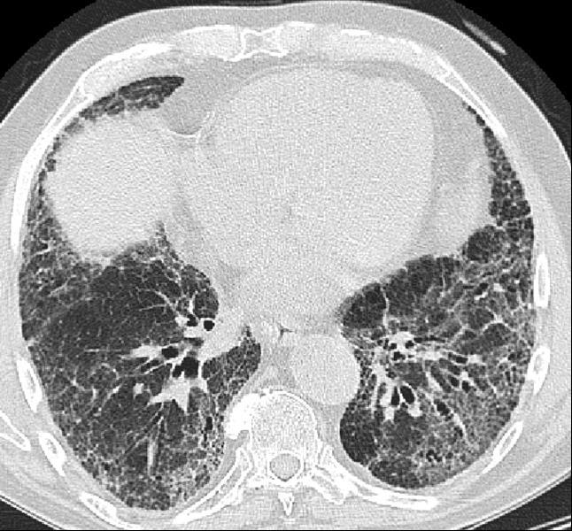 Radiológiai diagnosztika A chronicus HP és az IPF HRCT képének összehasonlítása