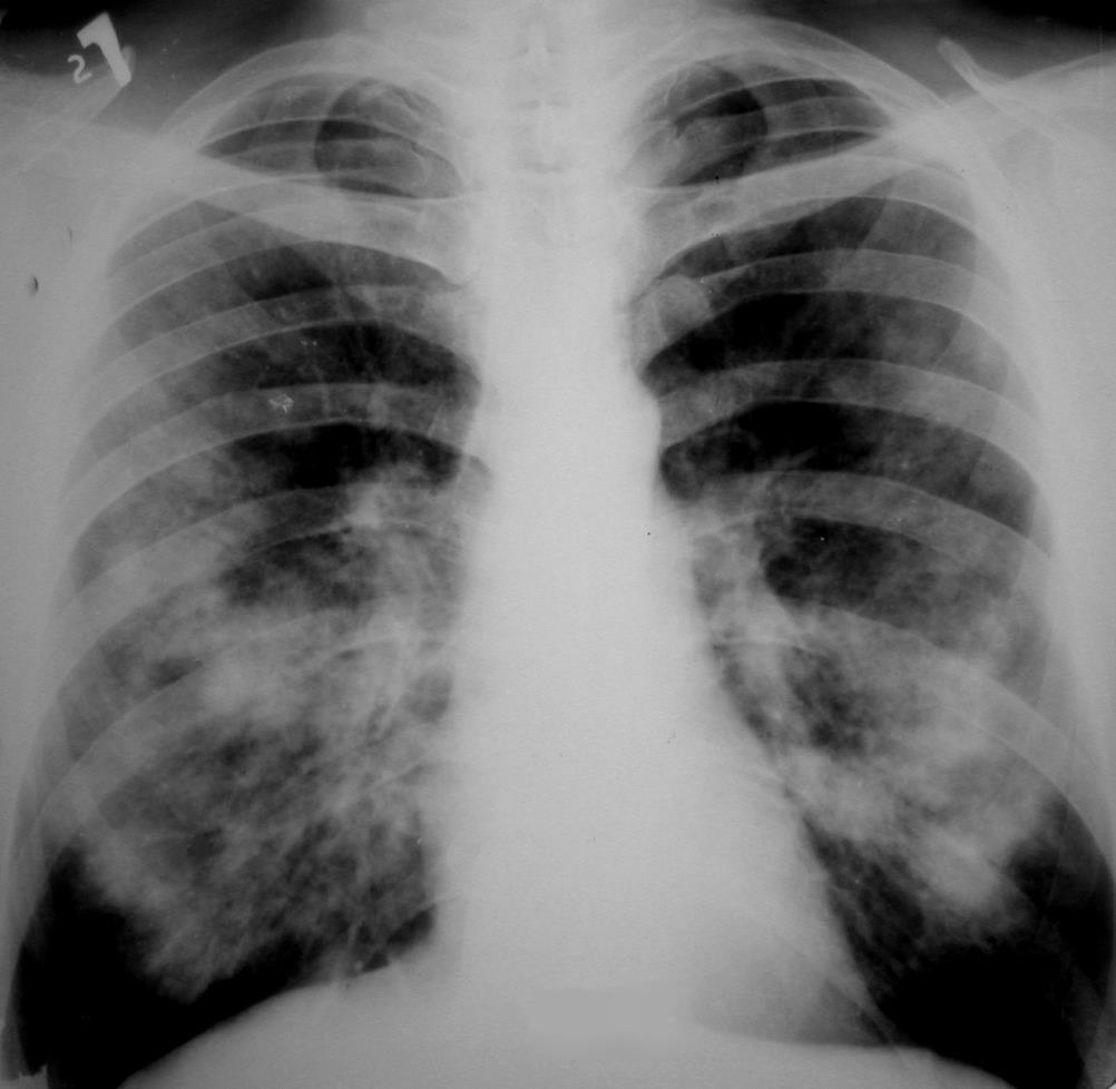 A hiperszenzitív pneumonitis klinikuma I.