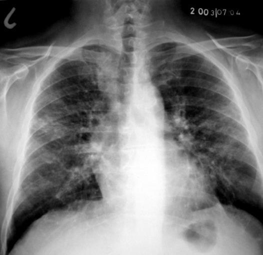 A hiperszenzitív pneumonitis klinikuma. II. A szubakut- idült pneumonitis Tartós és alacsony intenzitású antigénexpozíció mellett (pl.