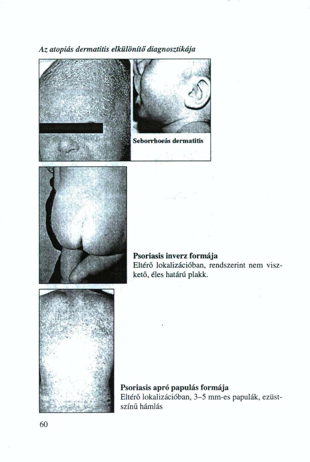 Az atopiás dermatitis elkülönítő diagnosztikája Psoriasis inverz formája Eltérő lokalizációban, rendszerint nem