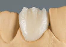 Alternatív megoldásként BASE DENTINE teljes anatomikus rétegezése, közes polimerizálás, majd Cut Back egy finom fogazású keményfém maróval.