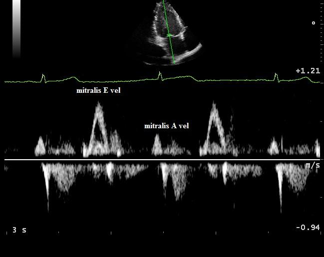 5. ábra - Mitrális beáramlási görbe Ezenkívül a szöveti Doppler (TDI) mérések