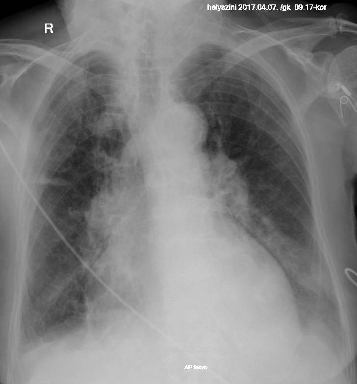 90 éves asthmacardiale cardiale-hfpef Felvétel NT-proBNP:4193 pg/ml