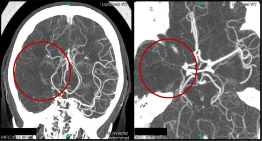 CT-angiographia