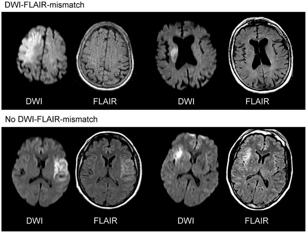 Diffusio-súlyozott felvétel acut ischaemiás stroke-ban