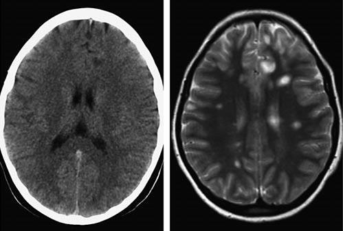 MRI sclerosis multiplexben (MS) CT nem