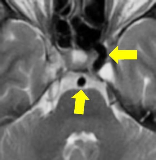 Flow voiding Normalis