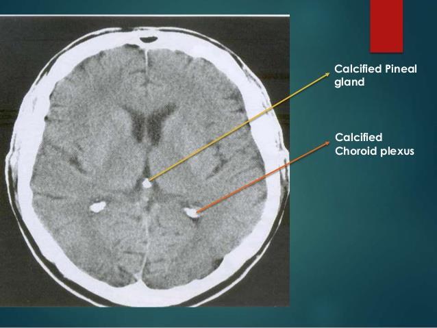 CT (natív vagy post-contrastos) A laesio lehet hypodens, isodens, vagy hyperdens hypodens: levegő,