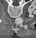 aorto-oesophagealis