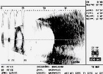 A mode (measurement of reflected US -- distance