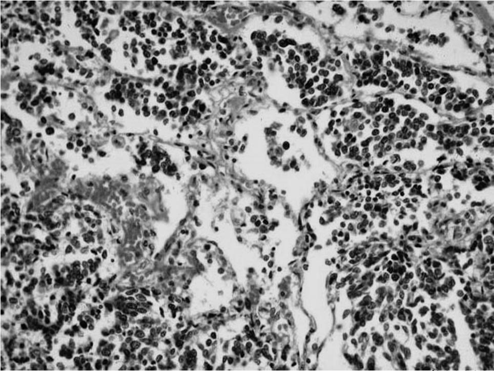 Kissejtes rák MYCL1: ampl, N-MYC: amp FGFR1: ampl SLIT2: mutáció EPHA7: mutáció CREB: mutáció MLL: