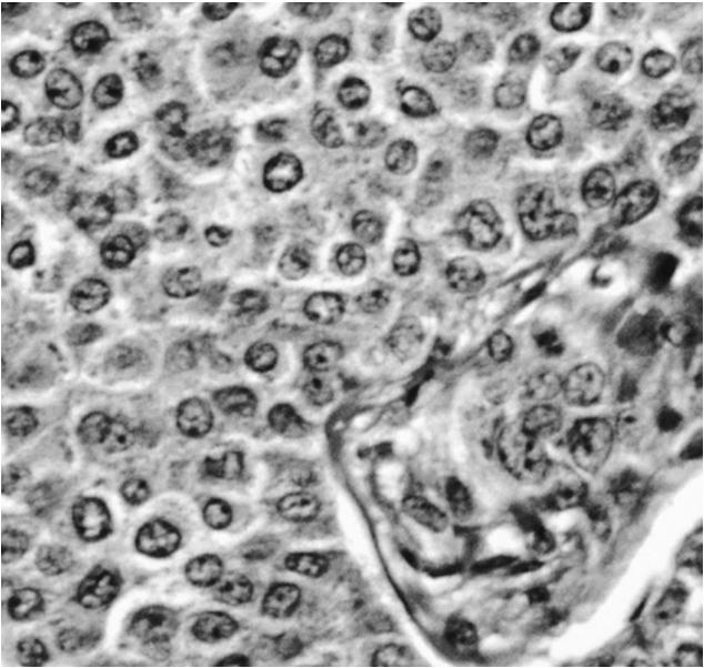 4%) Medulláris carcinoma (1.