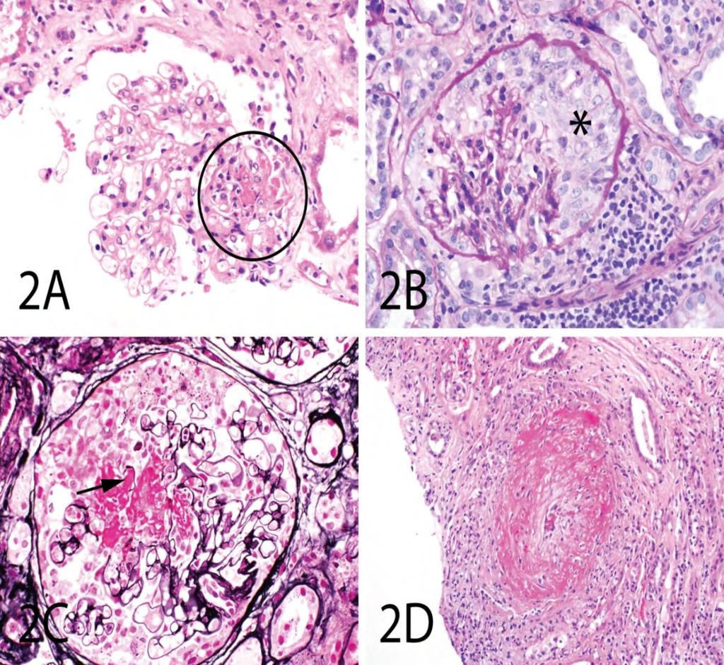 Veseelváltozások A, Segmentalis necrotizáló glomeruláris laesió MPA-ban B, A segmentalis necrotizaló laesió után a félhold napok alatt alakul ki.
