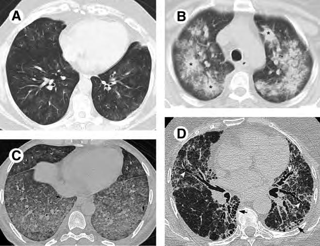 MPA tejüveg homály GPA Többszörös granulomák SLE Diffúz Tejüveg homály, csomók MPA pulmonalis vérzés után Diffúz alveolaris hemorrhagia különböző CT mintázatai.