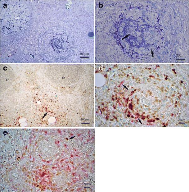 MPO-ANCA pozitív polyneuropathiával járó MPA-s beteg nervus suralus biposziás mintájának immunpathológiai jellegzetességei JTakeuchi H et al. 2017 Clin Rheumatolan 26.