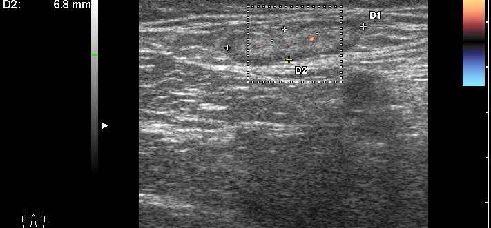 proximalis tibialis leiomyosarcoma. Tumor prothesis.