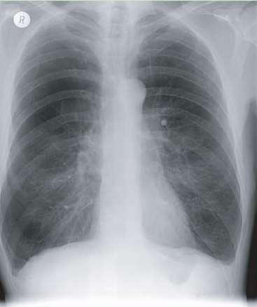 Előrehaladott emphysema Nagy térfogatú tüdők keskeny szívárnyékkal A rekesz mindkét