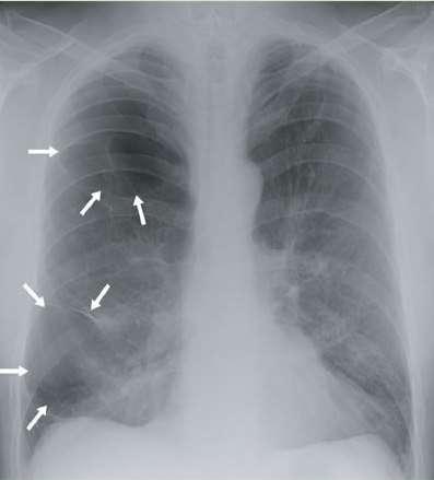 Bullosus emphysema A felső bulla érmentes területként látható a jobb felső lebenyben.