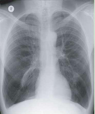 α 1 -antitripszin hiány (panacinaris emphysema) nagy térfogatú tüdők