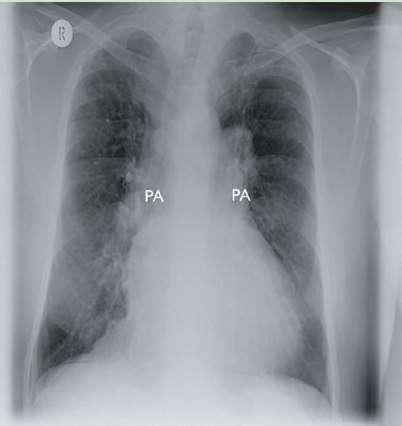 érrajzolat csökkent Cor pulmonale Krónikus légúti obstrukció, midkét oldalon