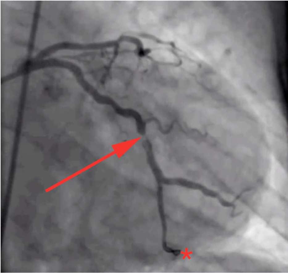 EKG-ban képalkotó eljárással bizonyított, új szívizom elhalás vagy új