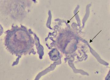 megbetegedések esetén (felszíni MHC I molekula hiányát érzékeli) Photomicrograph of DCs stained with May-Grunwald Giemsa-Tan et al. 97 Malaysian J Pathol 2010; 32(2) 8.