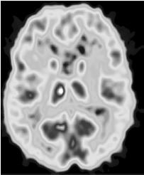 Normál agyi ( 18 F)FDG-scan PET diagnosztika Alacsony grádusú astrocytoma PET alkalmazhatósága Nagy érzékenységű, funkcionális vizsgáló módszer Informatív olyan funkcionális változásokról, amelyekről