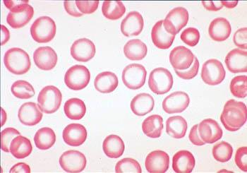 Microcyter anemia Alacsony MCV Kis méretű VVT