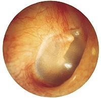 szőr - tragi CERUMEN 24 mm, S alakban görbült 10 mm porcos 14 mm csontos Mélyén a membrana