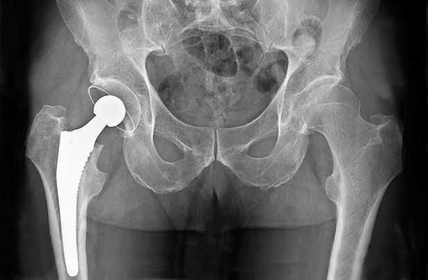 Biokompatibilitás, biofunkcionalitás Biokompatibilitás: összeférhetőség az érintkező szövetekkel és a szervezettel (hemokompatibilitás is) Szerkezeti összeférhetőség (forma, mechanika, pórusos
