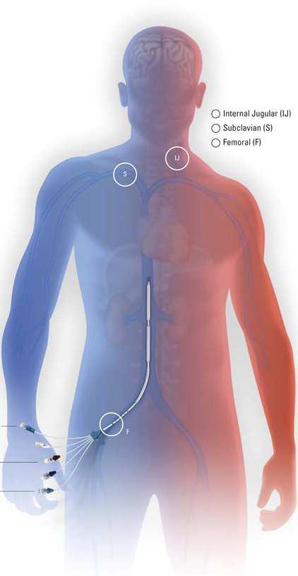 Endovascularis