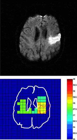 Cerebralis hyperthermia, thermopooling A cerebralis hőmérséklet egészségesekben is magasabb, mint a maghőmérséklet Neurológiai károsodás során ez további 0.1-2.