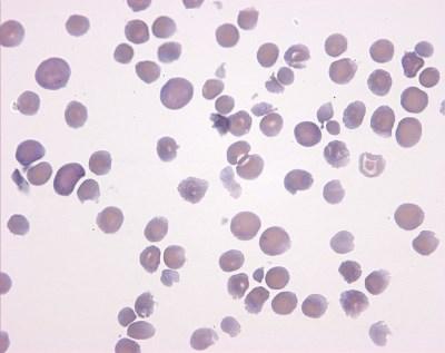 Atípusos hemolitikus urémiás szindróma (ahus) potenciálisan halálos, ritka vesebetegség 2 eset / 1,000,000 fő / év