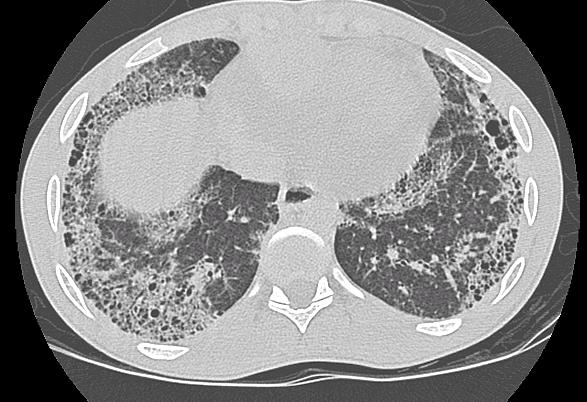 Pulmonalis manifestatio Diffus sclerodermában (dcssc) gyakori Limitált sclerodermában (lcssc) valamivel gyakoribb Alveolitis / pulmonalis fibrosis Interstitialis pneumonitis Csökkent diffusiós