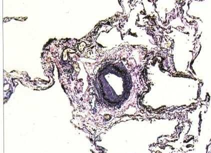 SSc-related pulmonary arterial hypertension (II) 3.